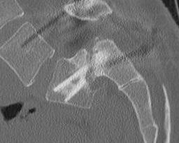 Dysplastic Spondylolithesis Bohlman Procedure